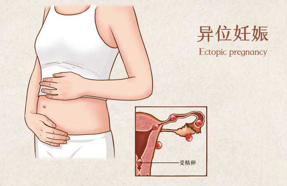 北京专业代孕网哪里有_北京代孕生殖中心选性别_孕早期发现阴道出血怎么办？