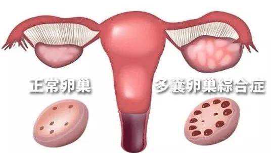 北京供卵机构_多囊卵巢不再懵！手把手教你调周期、促排卵