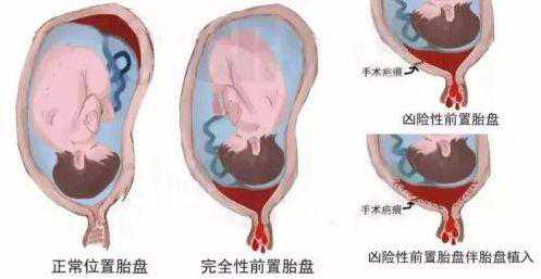北京有供卵试管生小孩的吗_怀孕了，胎盘位于前壁会有危险吗？