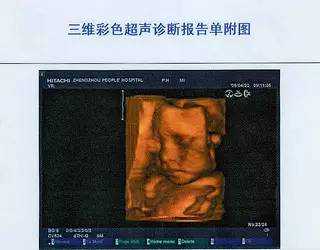 北京借腹生子怀孕_北京单身男女做试管婴儿费用_三维B超，妈妈做比孩子做更重